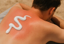 Poparzenia słoneczne i pentanol na plecach