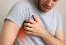 Wysypka od potu – co może być przyczyną i jak samodzielnie zdiagnozować problem? Mężczyza z wysypką od potu