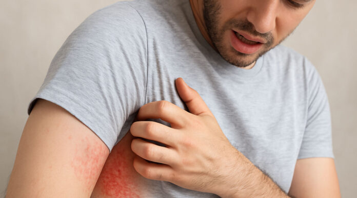 Wysypka od potu – co może być przyczyną i jak samodzielnie zdiagnozować problem? Mężczyza z wysypką od potu
