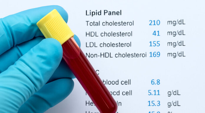 Lipidogram – co oznacza wynik i jakie są normy?
Wyniki badania lipidogramu