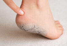 Stopa i skamieniała, pękająca pięta