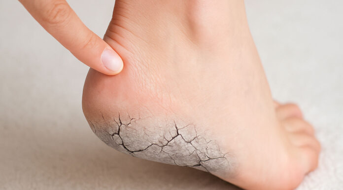 Stopa i skamieniała, pękająca pięta