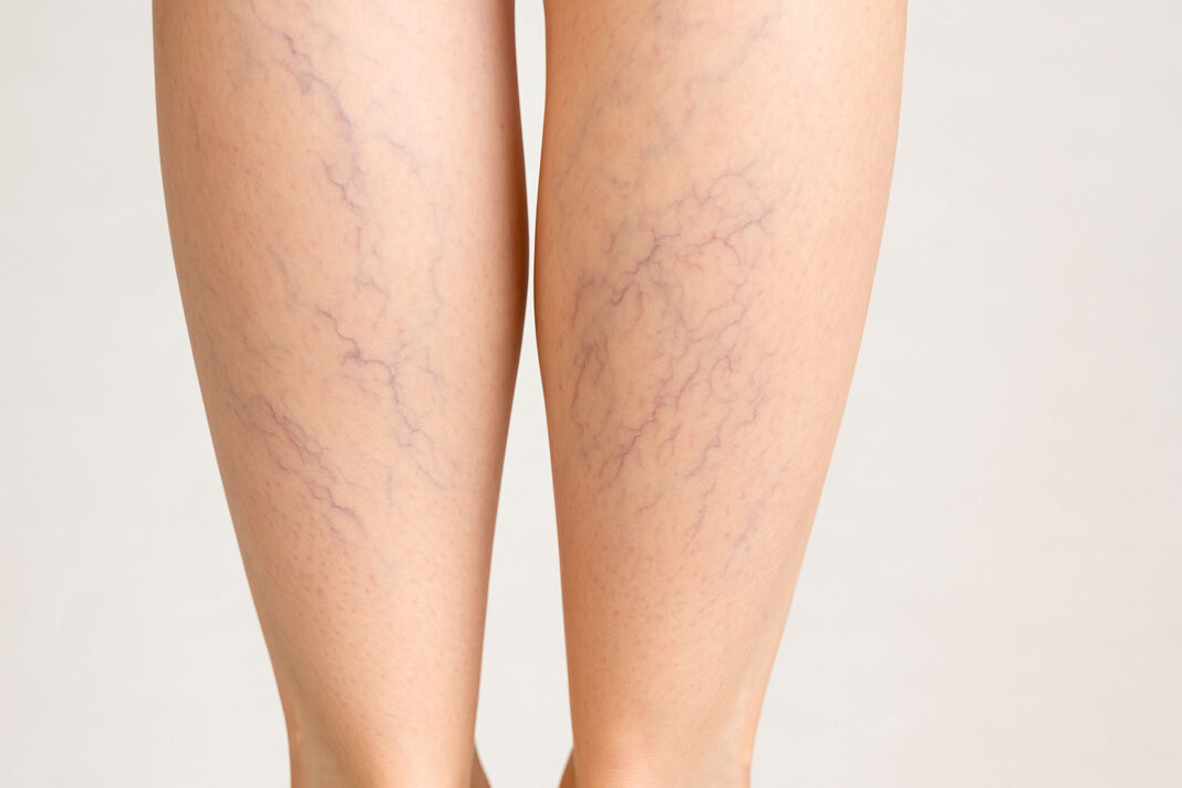 Zdjęcie łydek z widocznymi żyłami i żylakami