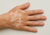 Ręka z białymi plamami na skórze (bielactwo)
