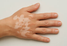 Ręka z białymi plamami na skórze (bielactwo)