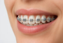 Uśmiechnięta kobieta w aparacie na zęby