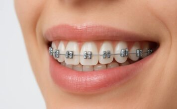 Aparat ortodontyczny – rodzaje i efekty leczenia Uśmiechnięta kobieta w aparacie na zęby