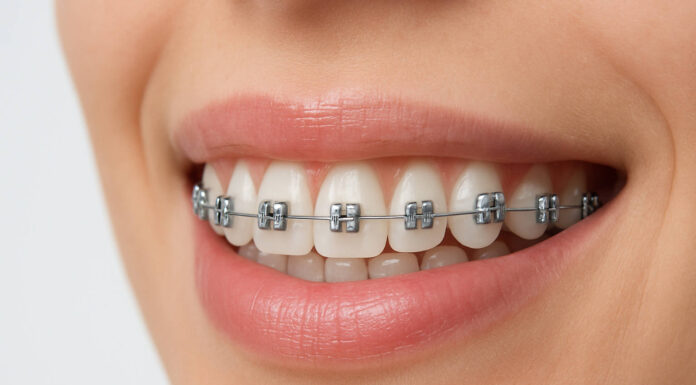 Uśmiechnięta kobieta w aparacie na zęby