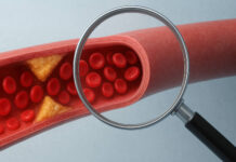 Zbliżenie na żyły i cholesterol blokujący przepływ krwi