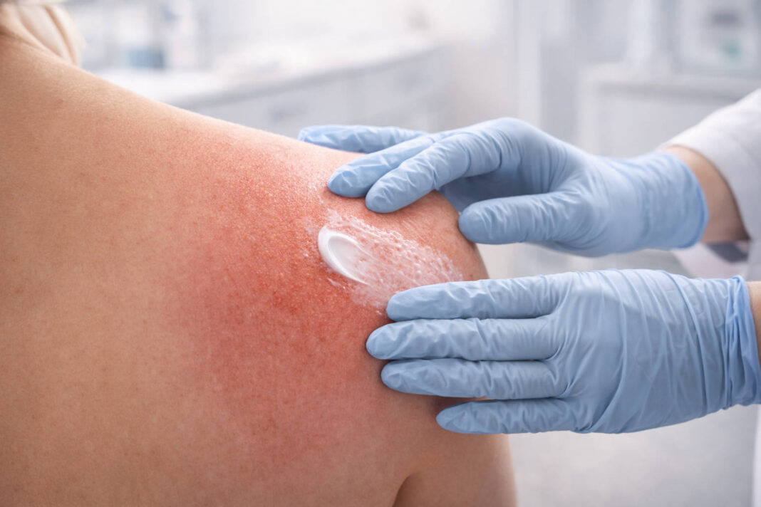 Zaczerwieniona skóra po radioterapii smarowana kremem