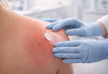 Zaczerwieniona skóra po radioterapii smarowana kremem