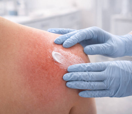 Zaczerwieniona skóra po radioterapii smarowana kremem