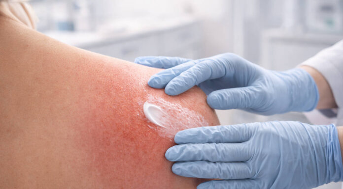 Zaczerwieniona skóra po radioterapii smarowana kremem