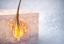 Przekrój skóry z trądzikiem (rysunek), w tle symbol chemiczny hormonów