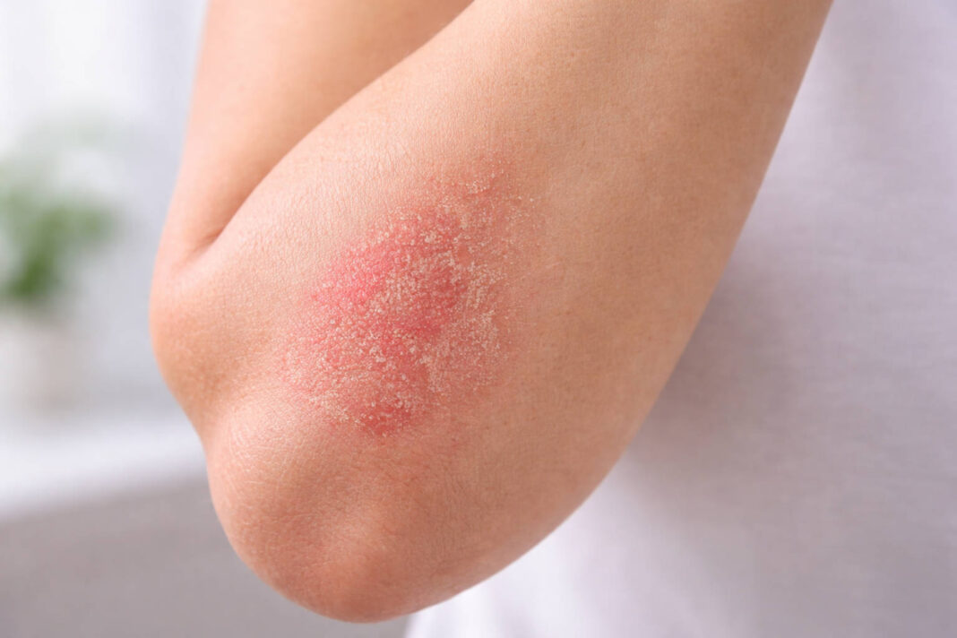 Zaczerwieniona skóra w stanie zapalnym charakterystyczna dla AZS