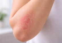 Zaczerwieniona skóra w stanie zapalnym charakterystyczna dla AZS