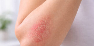 Zaczerwieniona skóra w stanie zapalnym charakterystyczna dla AZS