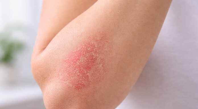 Zaczerwieniona skóra w stanie zapalnym charakterystyczna dla AZS