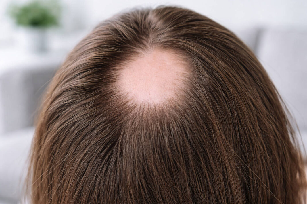 Łysienie plackowate, zdjęcie fragmentu głowy który wyłysiał