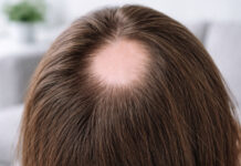 Łysienie plackowate, zdjęcie fragmentu głowy który wyłysiał