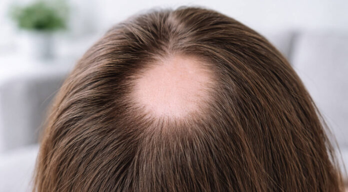 Łysienie plackowate – objawy, diagnostyka i pielęgnacja skóry głowy Łysienie plackowate, zdjęcie fragmentu głowy który wyłysiał