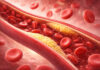Ilustracja żył zatkanych przez "zły" cholesterol LDL