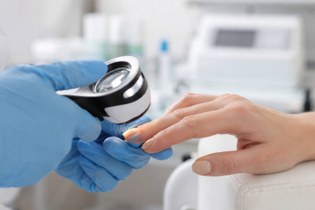 Badanie płytki paznokcia w trakcie wizyty u dermatologa/podologa. Diagnoza onycholizy