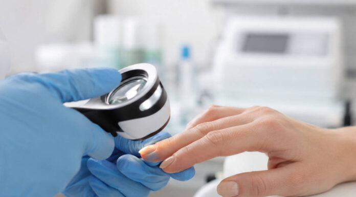 Onycholiza (odklejanie paznokcia od łożyska), powody i leczenie Badanie płytki paznokcia w trakcie wizyty u dermatologa/podologa. Diagnoza onycholizy